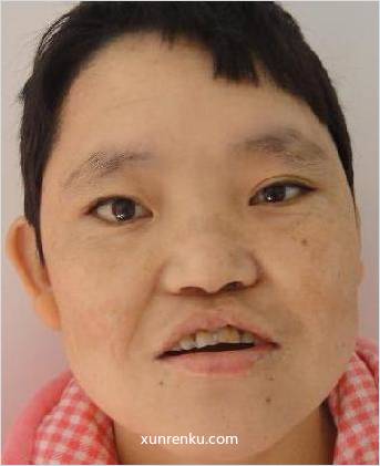 失踪人30岁(目测) 女 李芳 智力残疾 在温州市救助站
