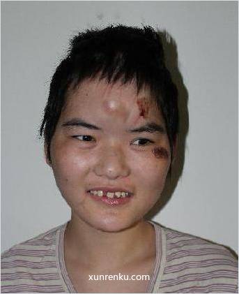 失踪人25岁(目测) 女 无名氏 智力残疾：智力残疾，反应迟钝 在张家港市救助站